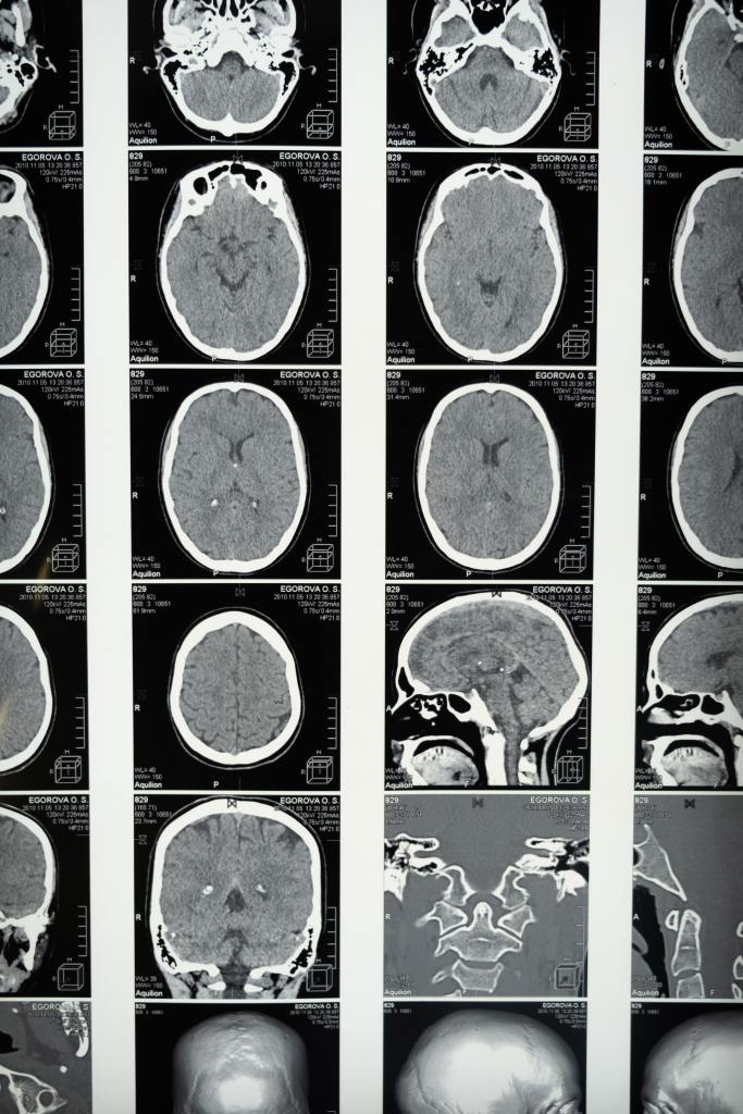 How does ketamine work? A picture of brain scans in black and white